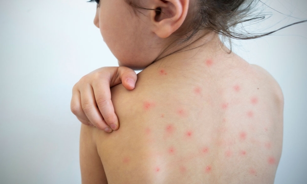  Alerta por nuevos casos de sarampión en el país